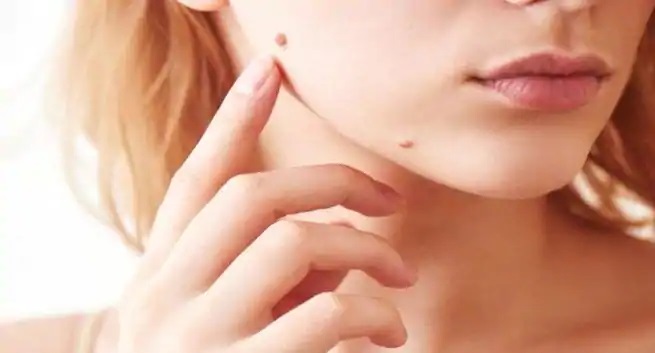 Simple and effective Home Remedies To Remove Skin Tags : Pak101.com